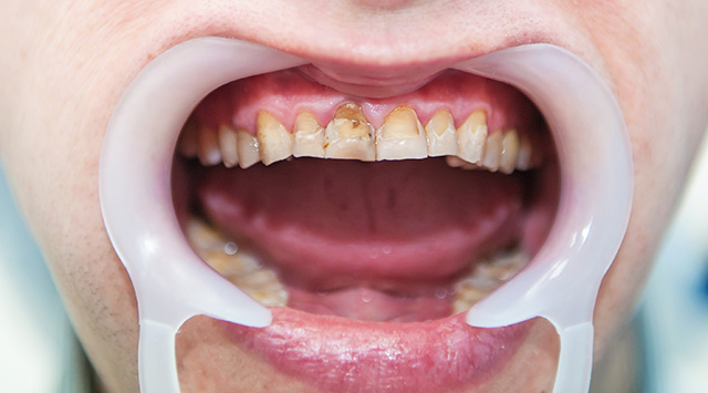 white spot on teeth