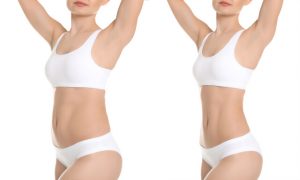 liposuction surgery before and after