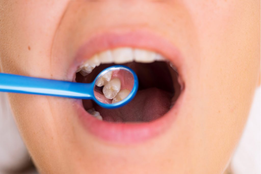 What to expect during gum graft healing time