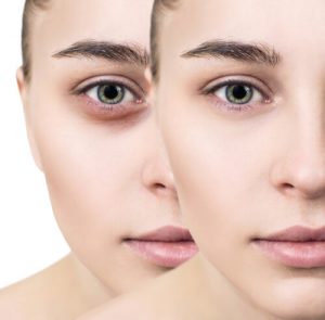 dermal filler under eyes treatment