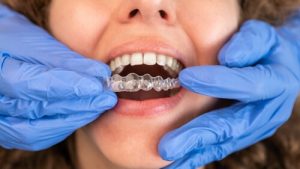 invisalign teeth attachments and buttons