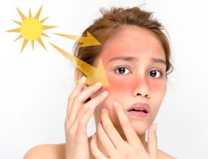 hydrocortisone for sunburn
