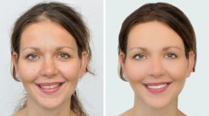 apply azelaic acid benefits