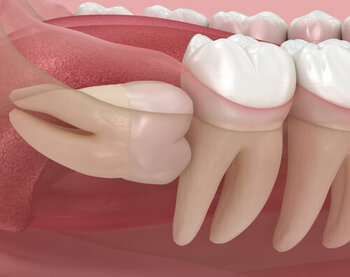 How Long Does Wisdom Tooth Pain Last impacted
